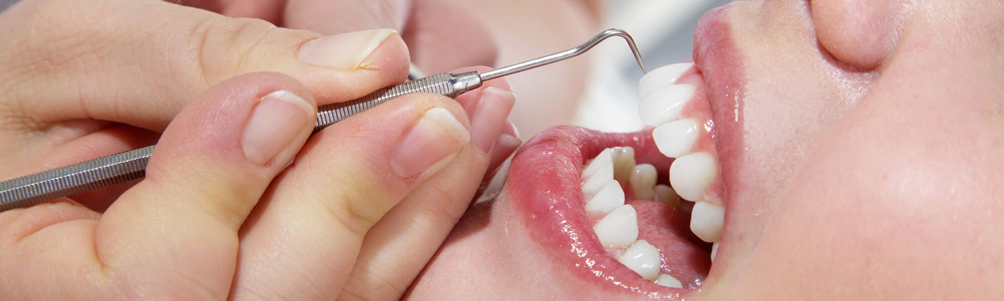 What Happens During a Dental Cleaning?