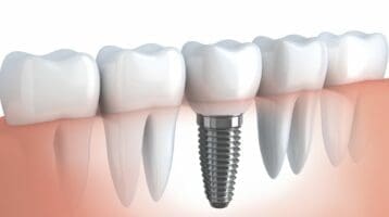 Dental-Implants