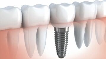 dental-bridges