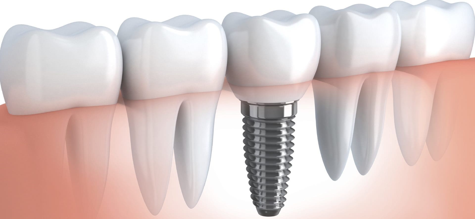 One Day Dental Crowns / CEREC Technology