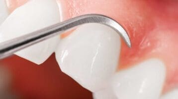 Gum-Grafting-Treatment